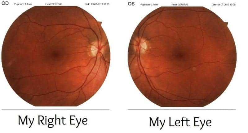 Specavers Retinal Images